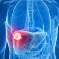 LIVER CANCER: Causes, Diagnosis, Symptoms and Natural Treatment