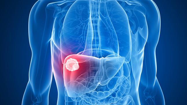 Cancer du foie ad0e7a5a9e7cd97ba060b0d25a8353d5c0507ed8