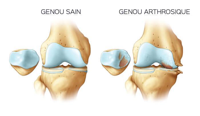 16 ALIMENTS POUR L'ARTHROSE